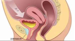 漏尿的常见病因有