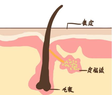 如何使用甲硝唑凝胶去黑头？