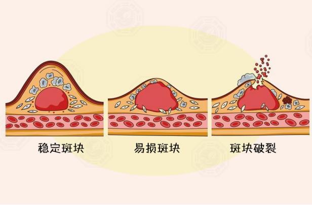 寒潮来袭时，别让心脑血管病找上门