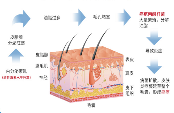 长不完的痘痘，上不完的火，上火长痤疮疼怎么快速解决？